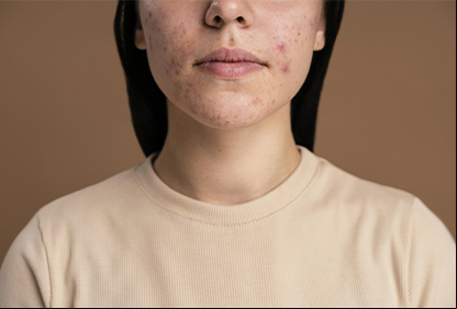 /21059alfenas-hoje-imagem-acne.jpg